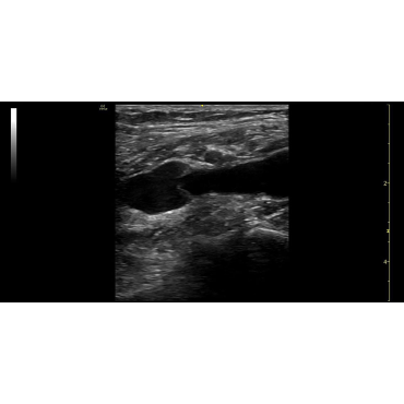 ultrasound image of the Popliteal vein using the 9L-RS ultrasound transducer